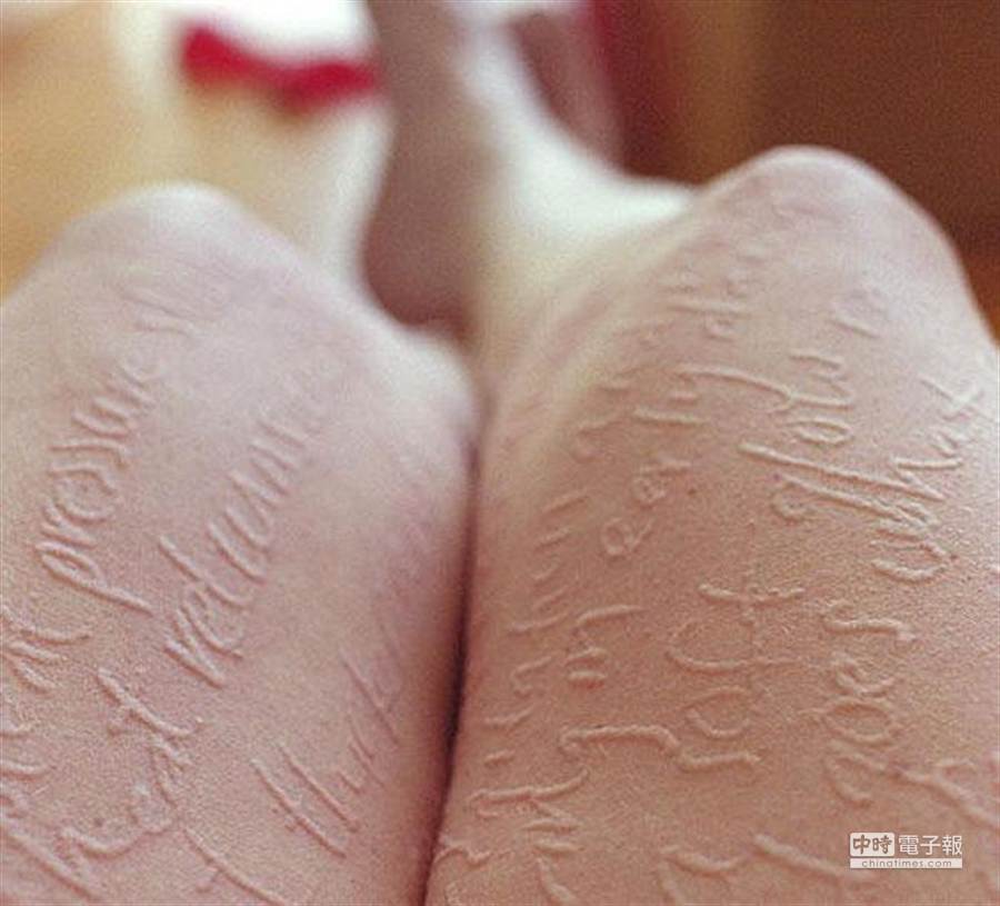 皮膚能寫出字跡，小心罹患了皮膚劃痕症。(翻攝網路)