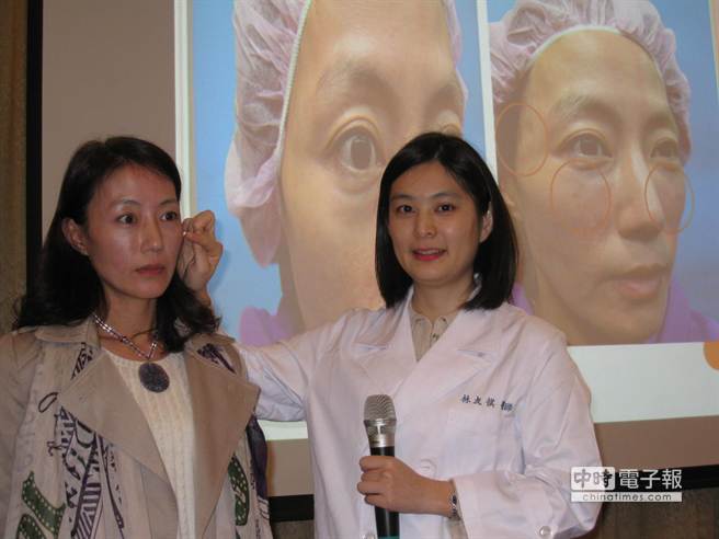 在林友祺醫師（圖右）建議下，吳小姐（圖左）接受玻尿酸微整型治療，在雙頰及太陽穴共施打4CC玻尿酸，治療效果不錯。（魏怡嘉攝）
