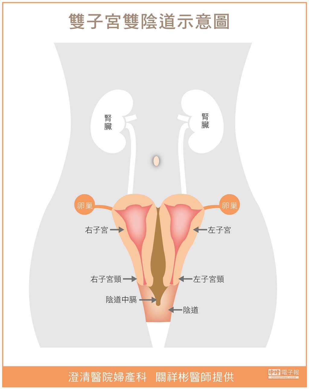 她 有 雙 子 宮 雙 陰 道 32 歲 單 邊 罹 子 宮 頸 癌- 生 活- 中 時 