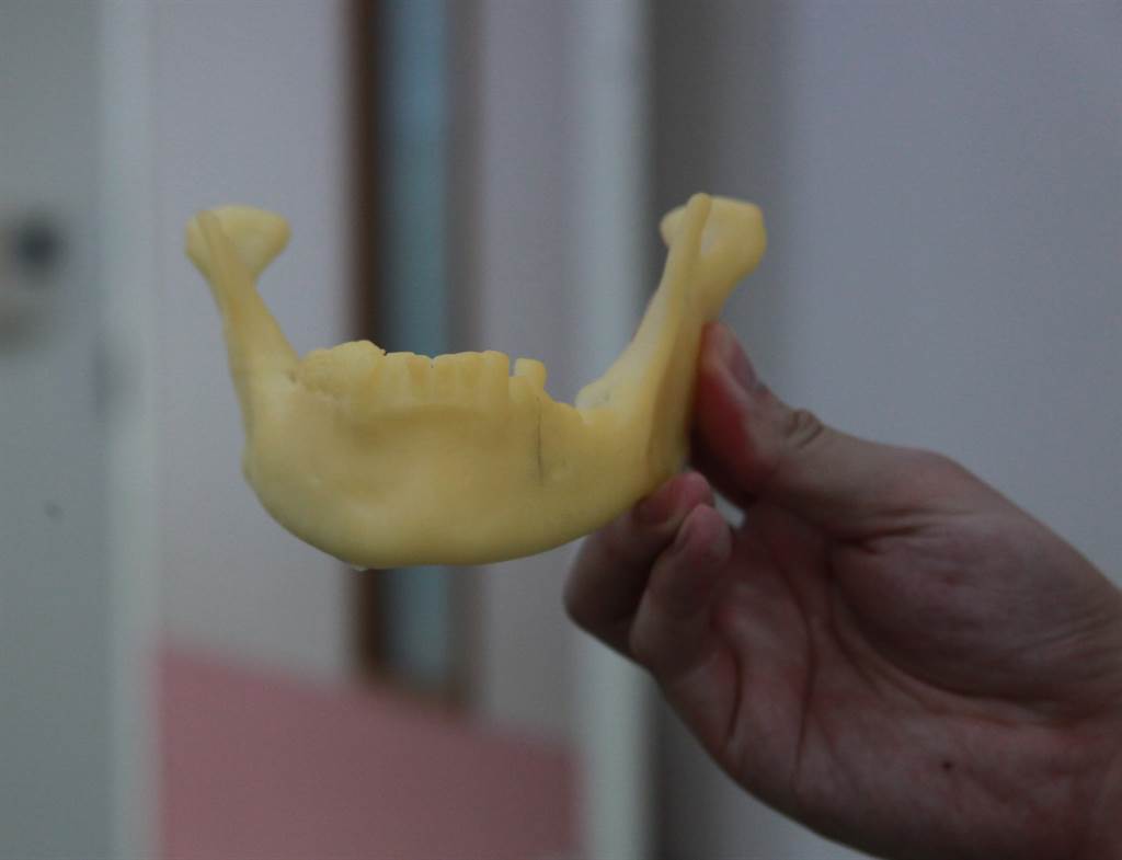 3d列印骨頭重建臉頰口腔癌阿公 開刀像沒開過刀 生活 中時