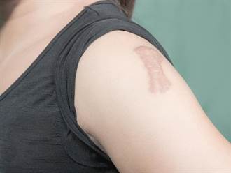 你的疤痕是哪一種？肥厚性疤痕vs.蟹足腫大不同