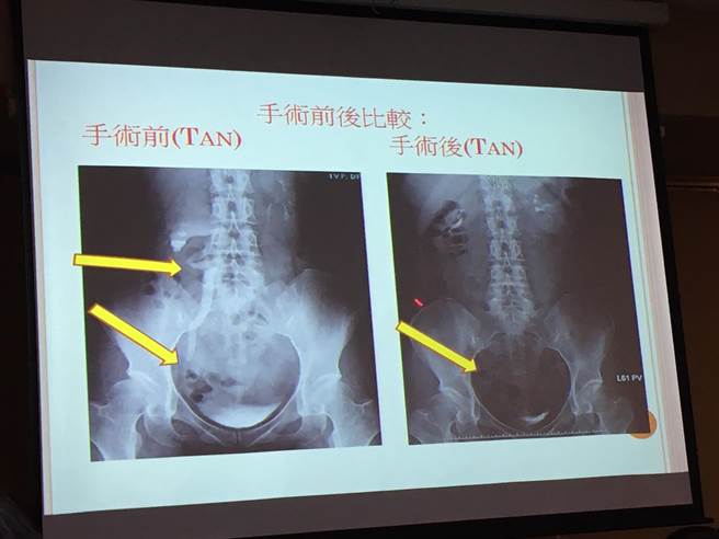 唐小姐手術前，輸尿管因狹窄（左側2個箭頭之間），而有彎曲變形、腎臟出現積水（左圖上方黃箭頭）的現象，右圖則為術後正常的輸尿管。（倪浩倫攝）