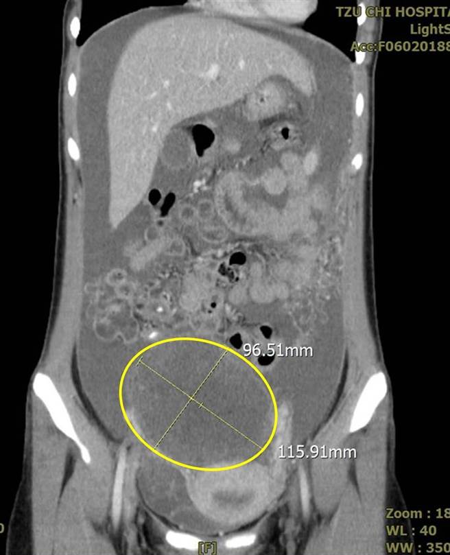 女大生連5天腹痛求診驚見大如葡萄柚卵巢癌腫瘤 生活 中時