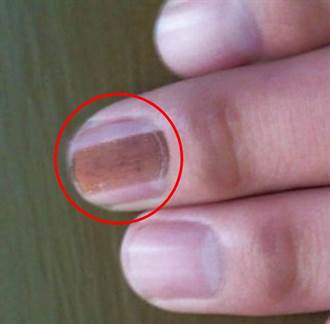 指甲裡長痣 小心變皮膚癌！