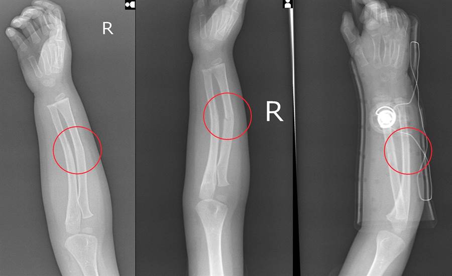 2歲男童手骨折用民俗療法喬骨更嚴重 生活 中時