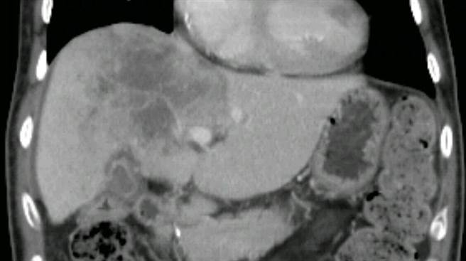 陳先生的肝癌分布在肝臟左右葉,超過10公分且侵犯到肝靜脈。(安南醫院提供)