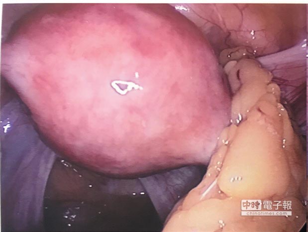 右側輸卵管：沾黏、阻塞