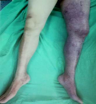 8旬翁腳急性靜脈血栓變紫紅 搶救保住腳