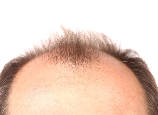 禿頭該怎麼救 名醫教你正確洗髮6步驟 健康 中時新聞網