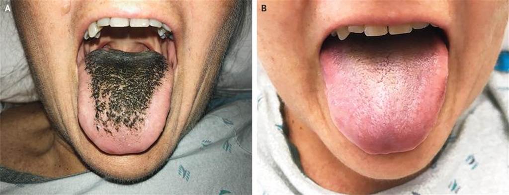 惊 车祸服用抗生素她舌头竟长满黑毛 生活 中时新闻网