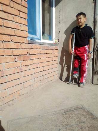 嬰兒時期摔斷腿 蒙古醫師害他長短腳 台灣醫療團隊伸援手