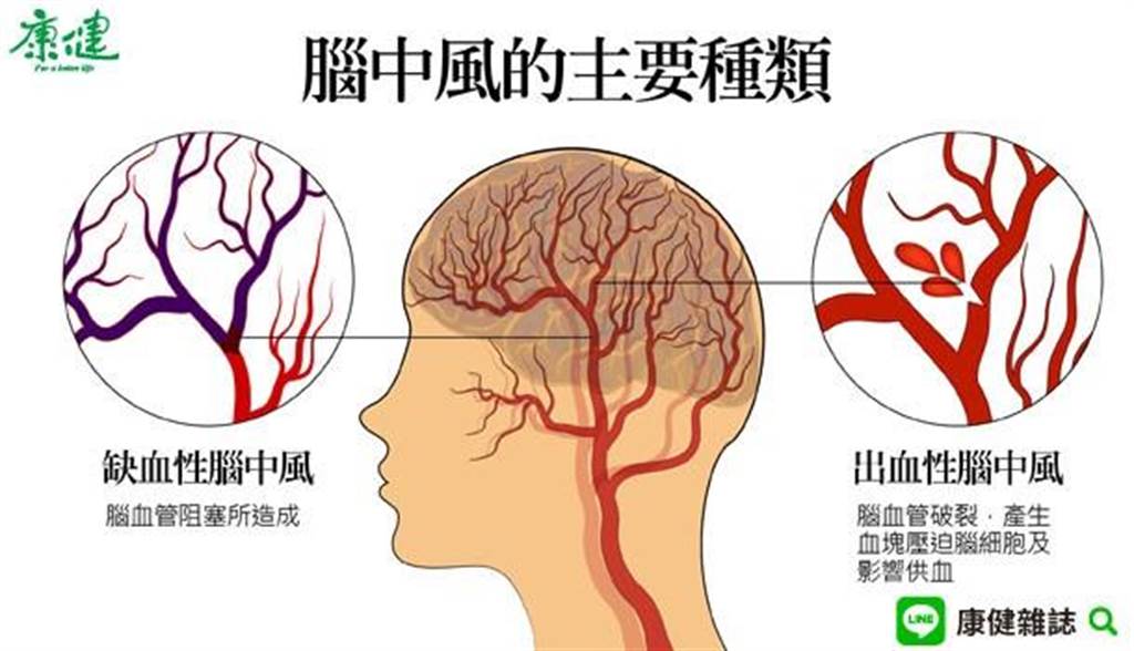 åˆ¥ä»¥ç‚ºæ˜¯å…¶ä»–ç–¾ç—…è…¦ä¸­é¢¨æœ€æ˜