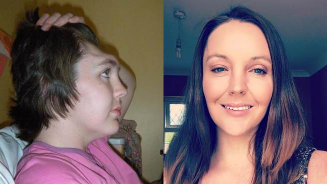 凯莉当时因为逞一时之快，没想到额头就此「消失」长达2年之久。（图／翻摄自Gráinne Kealy脸书）