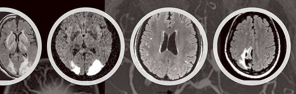 救援雷擊頭痛新技術解析腦部特徵 生活新聞 中國時報