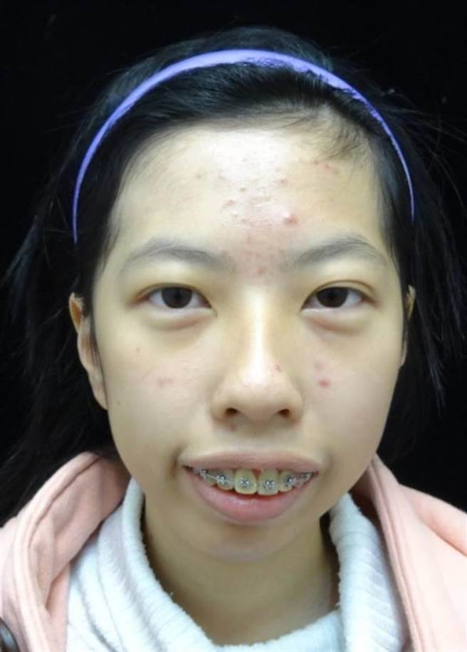 王小姐因咬合不正，下顎後縮，生活品質大受影響。（萬芳醫院提供）