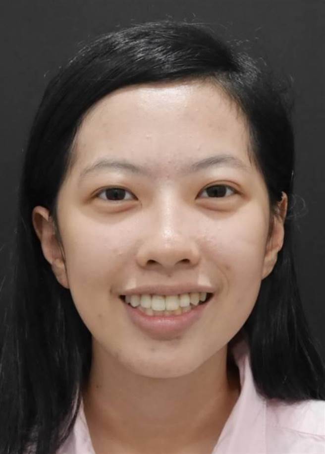 接受顳顎關節整合治療後，王小姐終於可以展現自信笑容。（萬芳醫院提供）