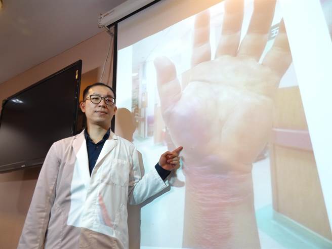 台中榮總重建整型外科醫師陳彥瑋指出，男子到院時左手前臂與手腕整個腫脹壞死差點需截肢。（馮惠宜攝）