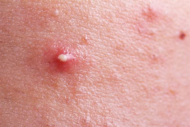 女腋下長巨痘用力一擠膿汁大噴射 搜奇 網推