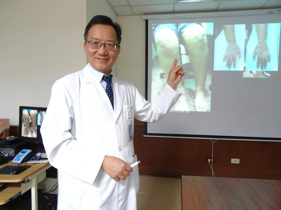 中山醫學大學附設醫院過敏風濕免疫科主任魏正宗指出26歲小榕，全身多處紅疹與抓痕，令人心疼。（馮惠宜攝）