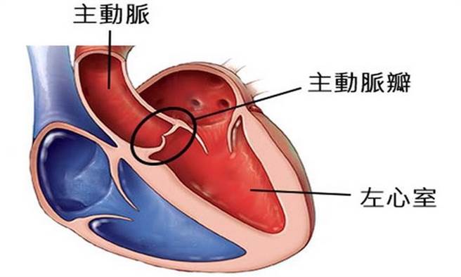 主動脈病變是心臟瓣膜手術常見主因。（圖片來源：取自台灣心臟外科研究發展協會）