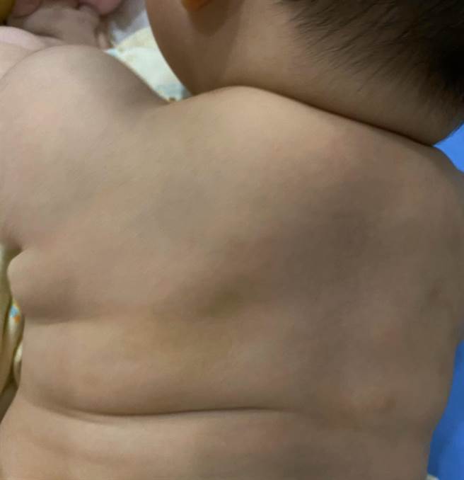 台中市南屯區一處托嬰中心傳出虐嬰事件，受害女嬰身上多處瘀青。（張耀中服務處提供／黃國峰台中傳真）