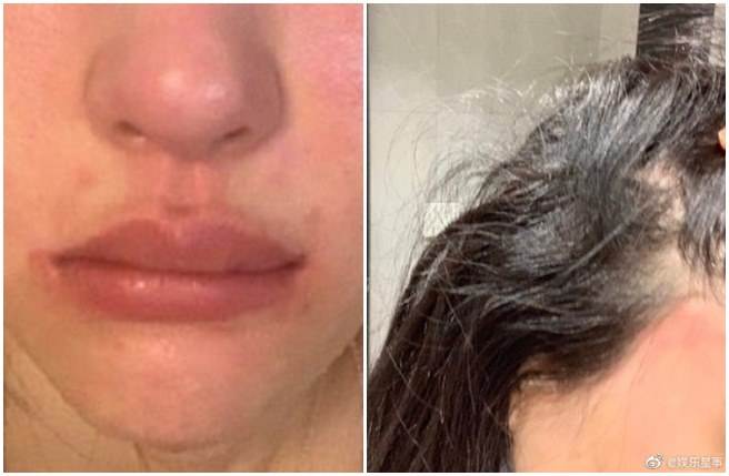 潘南奎自爆被老板痛殴，嘴巴都歪了。(取自微博)