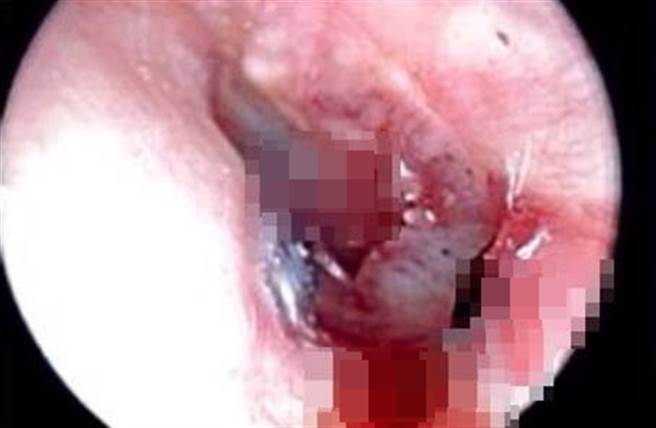 男子的耳膜破洞，还像香蕉皮般整个外掀，还留着一层皮瓣在上面。（图／吴昭宽医师独家授权提供）