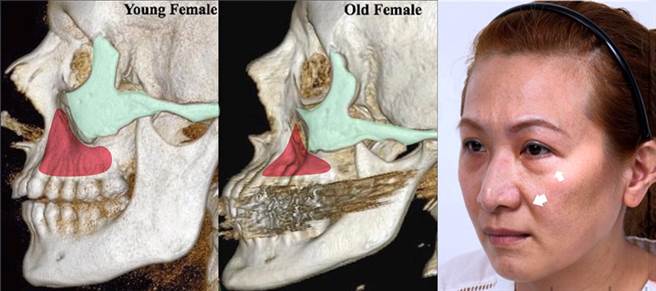 ▲法令紋與淚溝，和顴骨、眼眶骨、上顎骨的體積流失有很大的關係。由圖可見，從年輕到老年，骨頭體積明顯減少。（圖片來源：上立皮膚科診所）