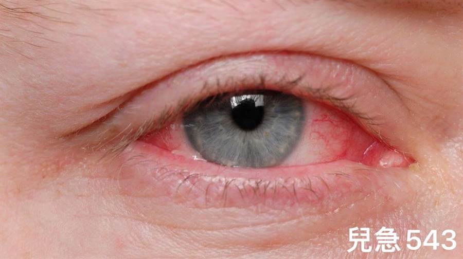 香港大學隊新冠肺炎最新研究，再度證實眼睛是病毒入侵人體的重要途徑。（摘自：來講兒科急診的543）
