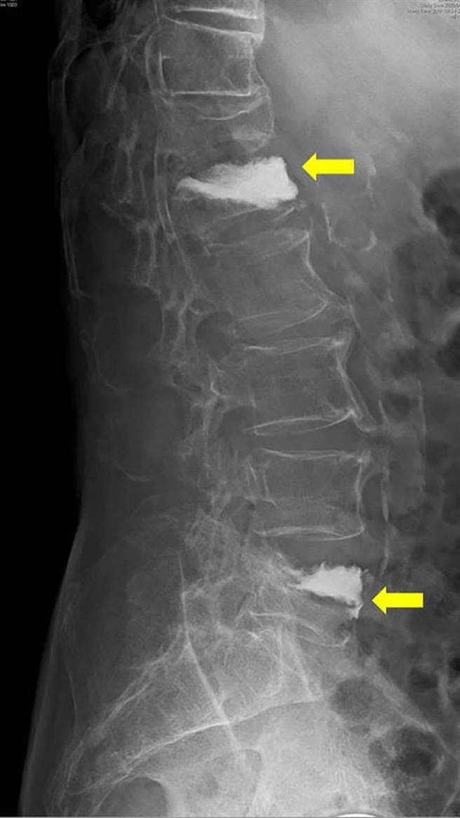 好痛喔 老婦2處脊椎壓迫性骨折拔個菜突跌坐在地 寶島 中時