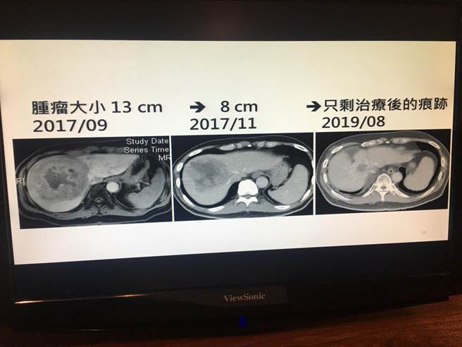 經過質子治療合併免疫治療，林先生的癌細胞已消失不見。（林周義攝）