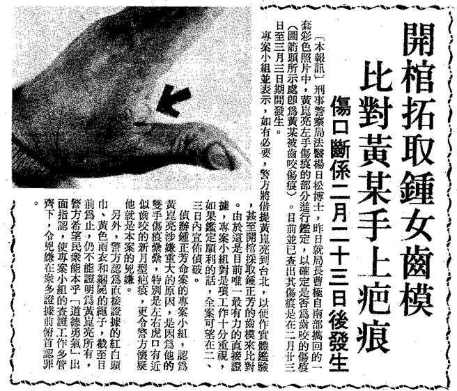 黄菎亮左手虎口的咬痕，警方认为是被锺姓女学生咬伤。（中时资料照）