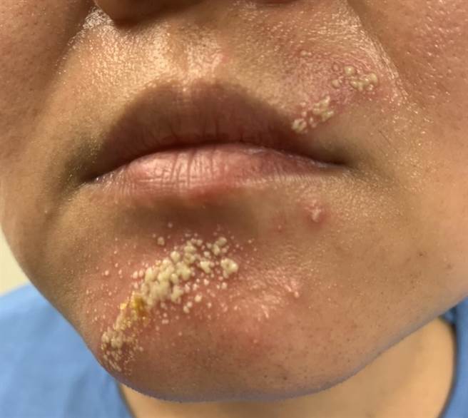 当皮肤接触到隐翅虫释放的毒素，将会出现红肿刺痛感，并长出水泡或脓疱。（联新国际医院提供／黄婉婷桃园传真）