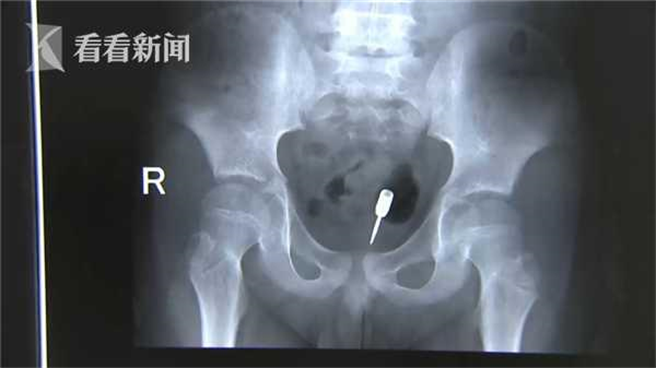 9歲男童「飛鏢塞肛門」超危急，結局大反轉：大便救了他。（圖／看看新聞）