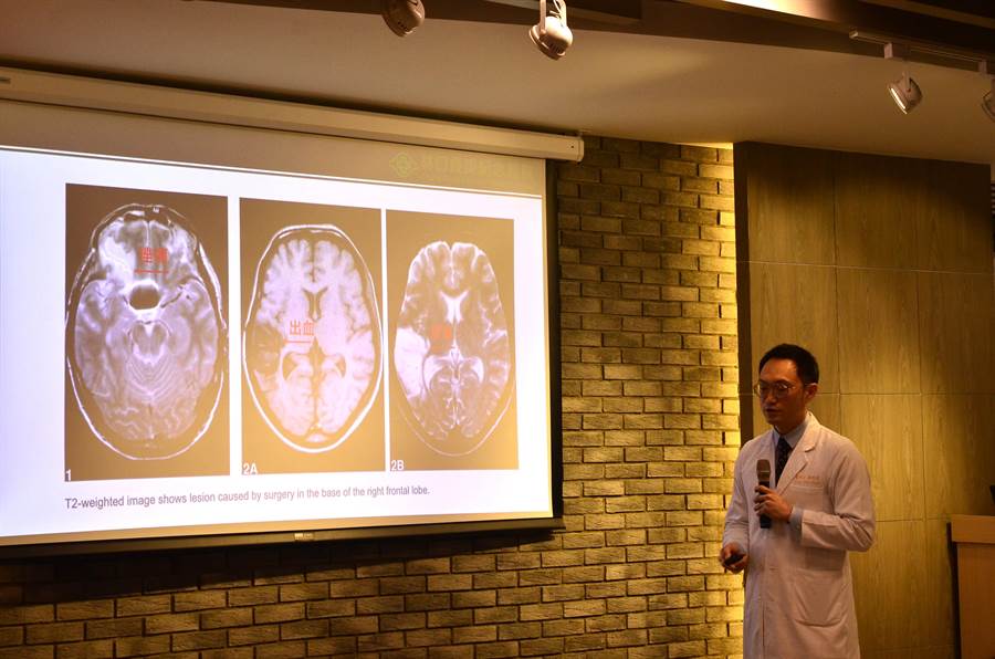 林口長庚醫師盧郁仁表示，傳統的開顱手術，為了使腦部被固定避免大腦受到傷害，並增加可視角及操作空間，需要透過牽引器固定腦部。（賴佑維攝）
