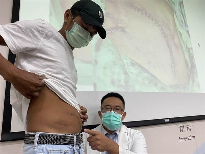 台中荣总整型外科医师蔡岳錤指出，周先生的伤口原本只有2公分，但因反覆感染，４度开腹清创。（冯惠宜摄）