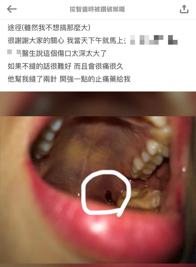 网友贴出自己喉咙的伤口照。(图撷取自Dcard)