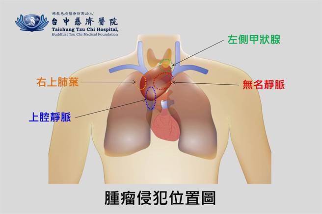 胸腺瘤侵犯位置示意图（台中慈济医院提供／王文吉台中传真）