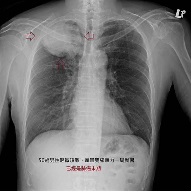 50多岁的男性患者、偶尔咳嗽一个多月，最近感到头晕双脚无力，就医全身健检后发现已经是肺癌末期。(图撷自苏一峰医师部落格)