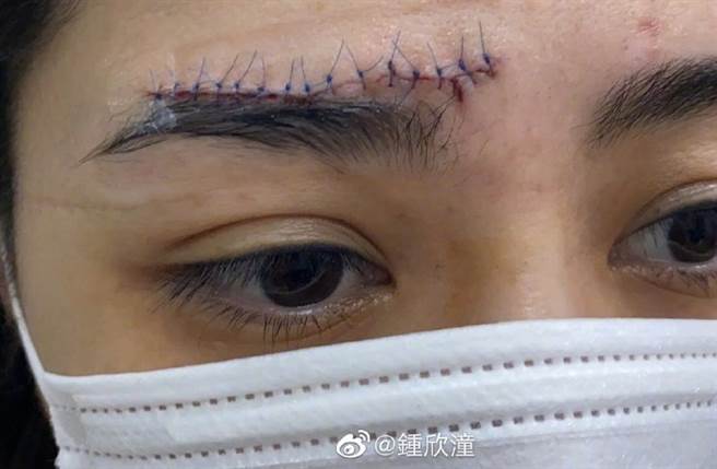 阿娇今日首度伤口照，向外界报平安。(取自阿娇微博)