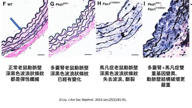 2014年美国马立兰大学研究，图中显示动脉壁弹性纤维染色的结构。 可以发现，多囊肾基因对动脉避的破坏不如马凡症。（图撷自李建璋医师脸书）