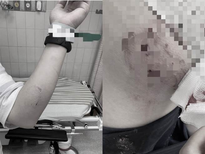 女饲主大腿更是被咬了2个1至1.5公分的洞(图/刘姓网友授权提供)