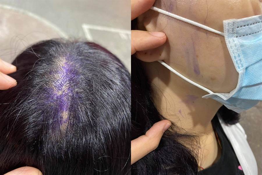 店家失手將染料弄到她的頭皮與脖子，圖片可見明顯紫色區塊。（臉書社團《爆怨公社》／蘇育宣翻攝）