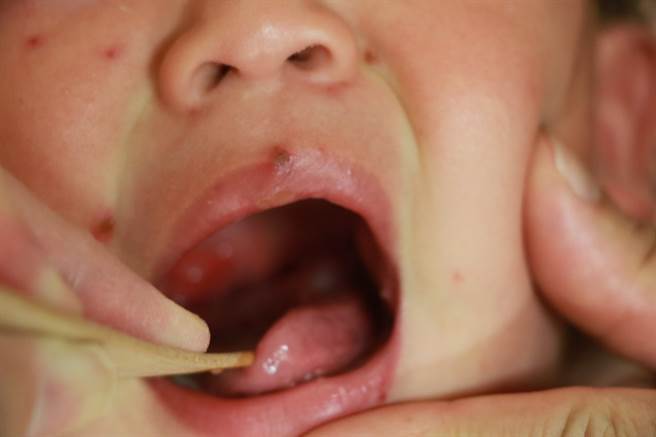 反覆高燒的小女嬰軀幹、四肢，甚至嘴巴都出現紅疹、紅色丘疹。（台中慈濟醫院提供／王文吉台中傳真）