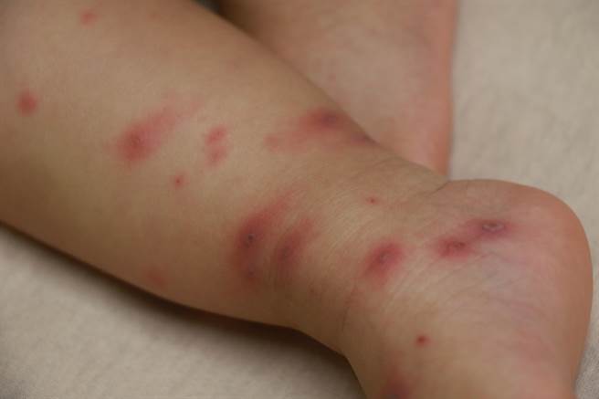 反覆高燒的小女嬰軀幹、四肢，甚至嘴巴都出現紅疹、紅色丘疹。（台中慈濟醫院提供／王文吉台中傳真）