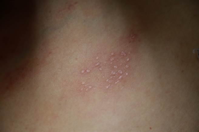 女嬰父親身上殘留帶狀皰疹（水痘）痕跡。（台中慈濟醫院提供／王文吉台中傳真）