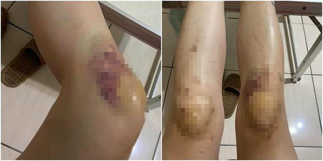 她惨摔后，整片膝盖瘀青，而总公司及维修师的回应却让她不能接受。（图／翻摄自爆料公社）