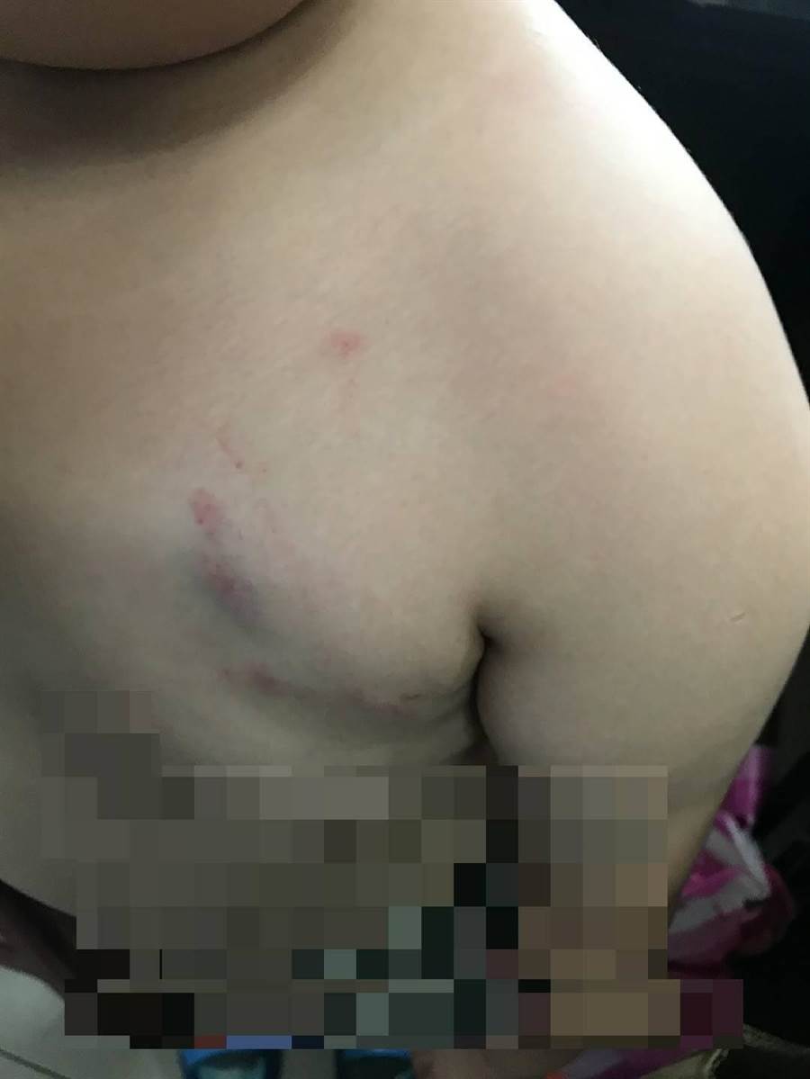 台南市歸仁區幼兒園疑傳管教不當，家長在臉書社團po出兒子左胸瘀青的照片，並向警局報案。（摘自網路／李宜杰台南傳真）