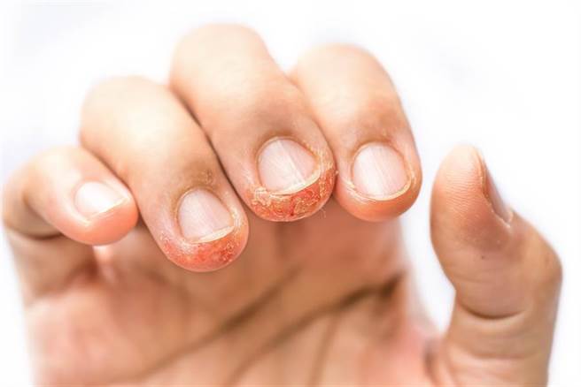 从指甲看出5大身体警讯！医曝：出现不明黑线恐致死。(示意图/达志影像)