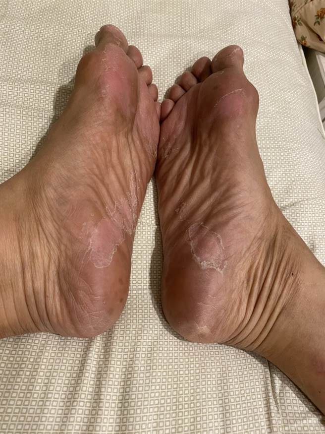 化疗期间，唐玲的肤色开始变深，脚掌开始脱皮。(照片/唐玲 提供)